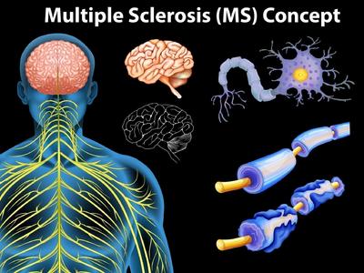 Multiple Sclerosis