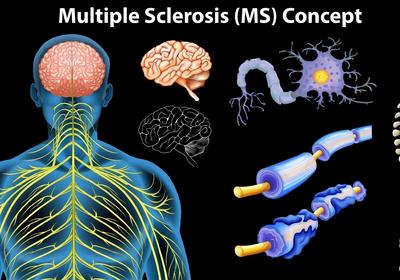 Multiple Sclerosis