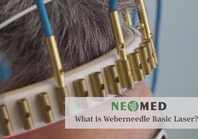 Weberneedle therapy