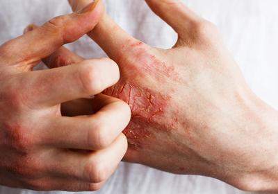 Overcoming Eczema through Nutritional Changes