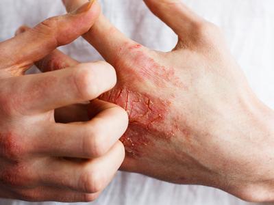 Overcoming Eczema through Nutritional Changes