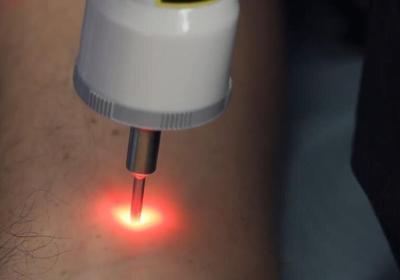 Low-Level Laser Therapy